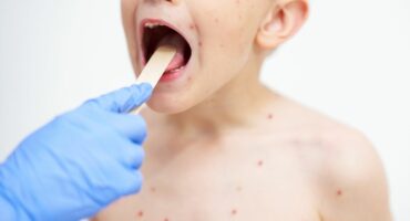 Chickepox vaccine in Stoke-on-Trent